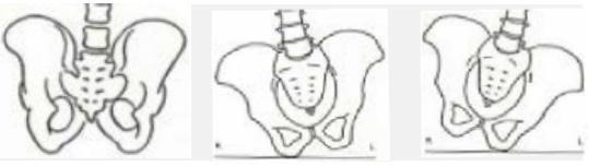 Pelvis — Oblicuidad (vista posterior)
